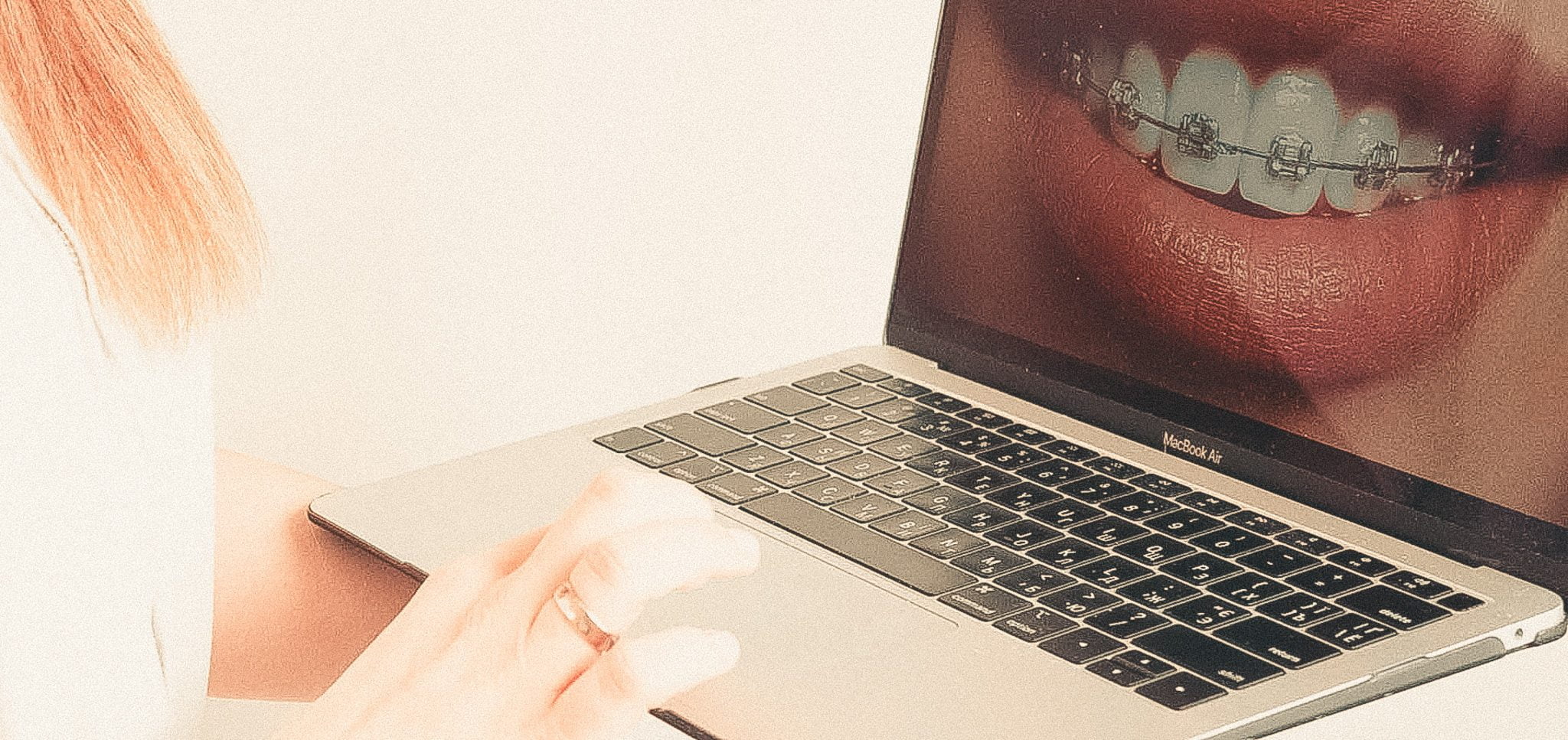 Лікування брекетами